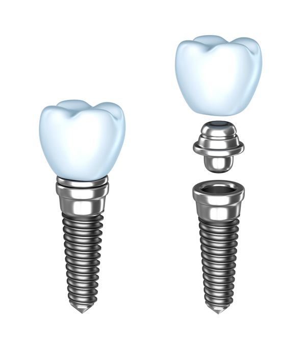 Dental implant