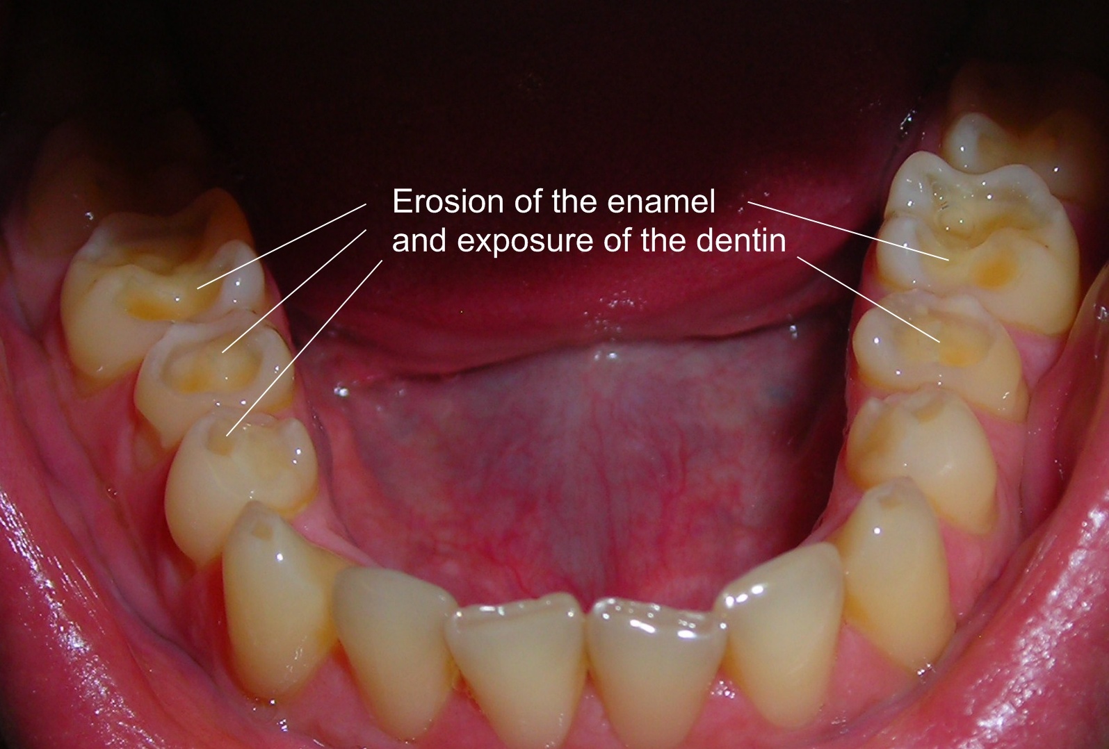 Enamel Erosion