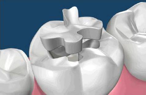 Porcelain fillings