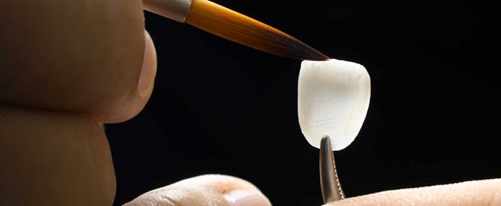 Porcelain Veneers