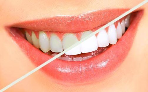Teeth whitening
