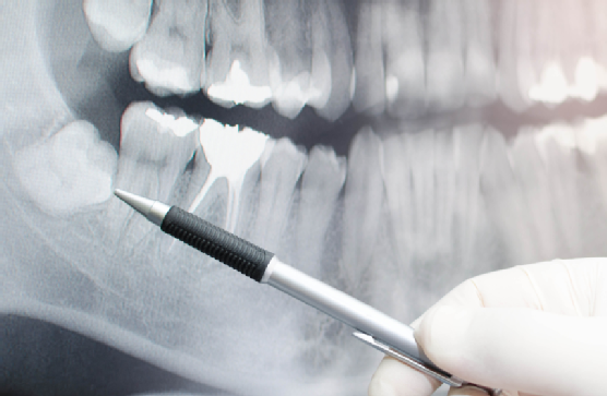 Did you know that X-rays help detect dental problems