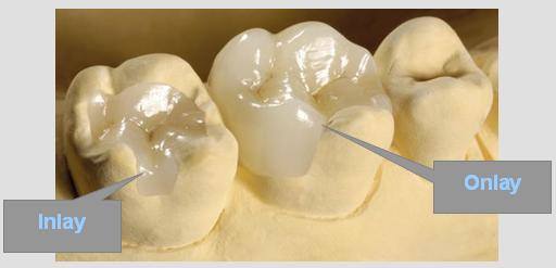 Dental Inlays and Onlays