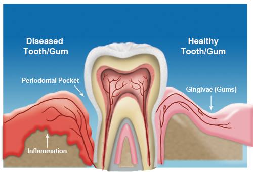 Gum Disease