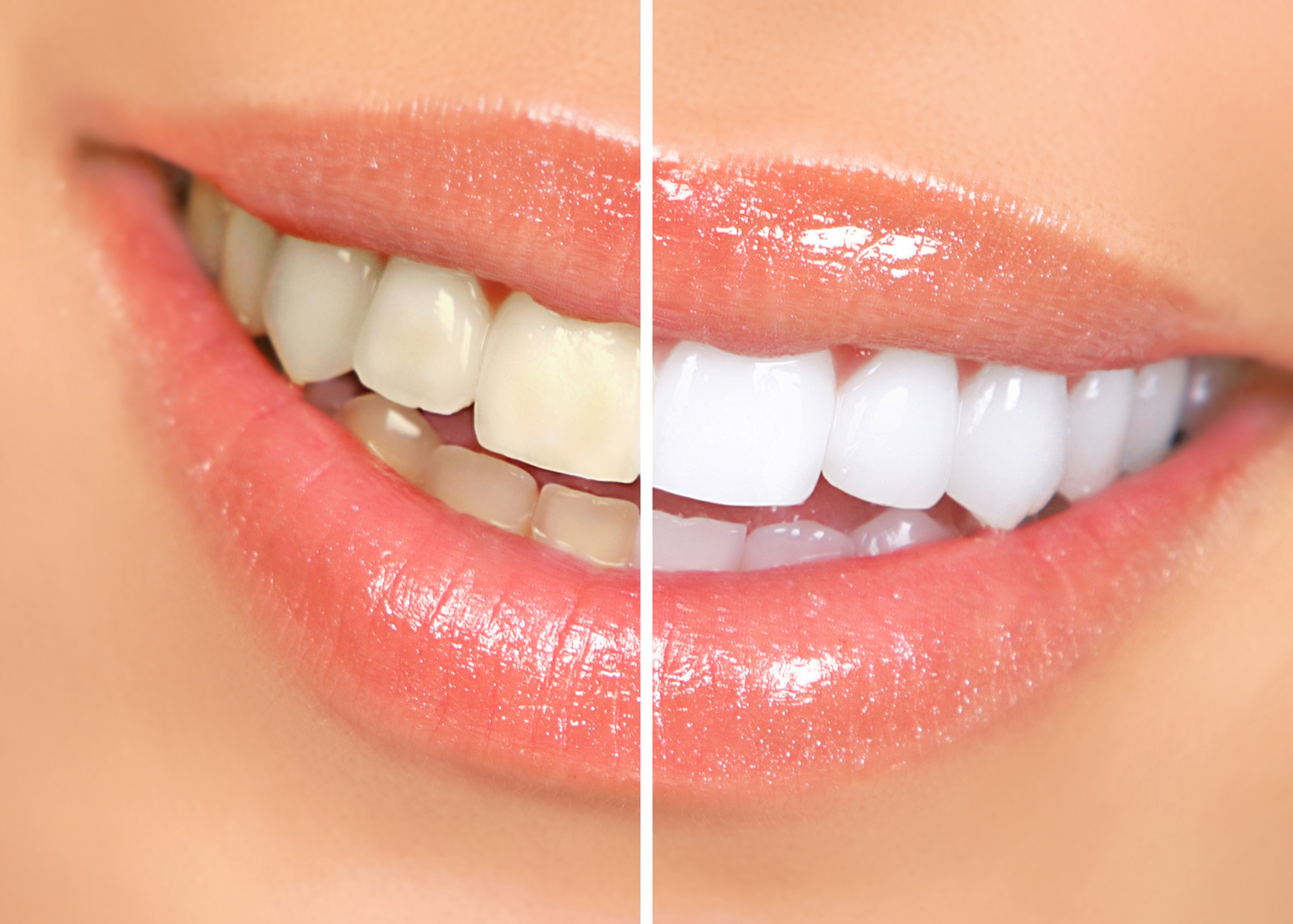 Whitening Veneer