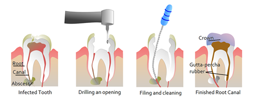 Root canal