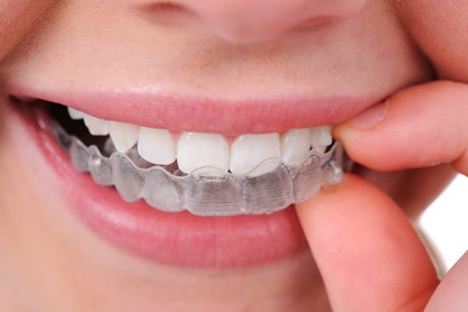 Do you know what type of braces is well suited for you?