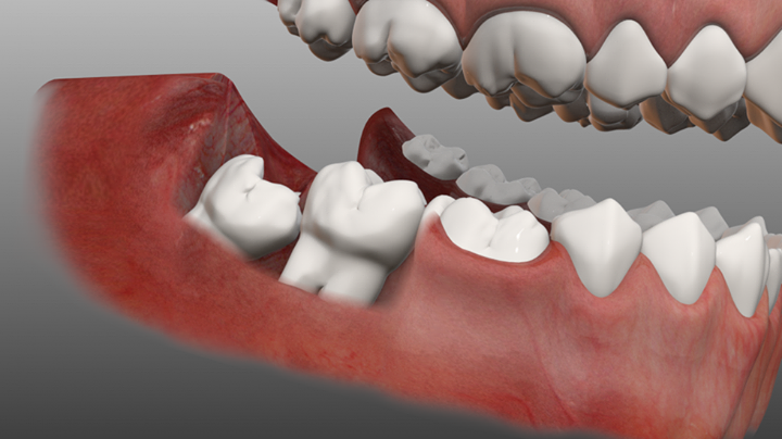 Wisdom tooth