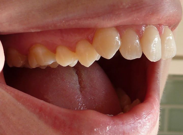 crooked teeth