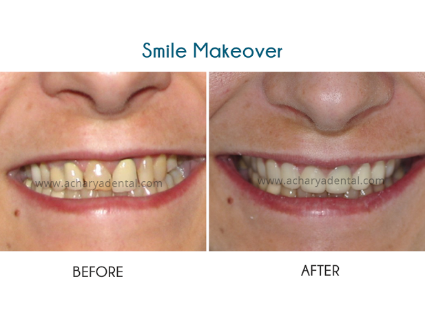 Sophias smile makeover