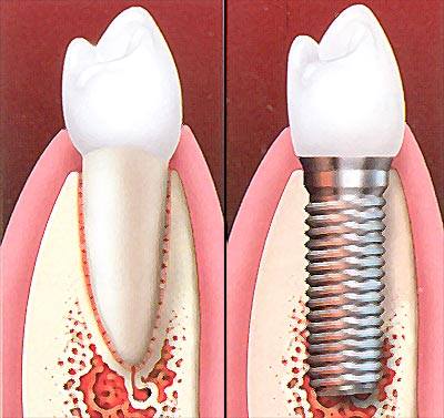 dental implant