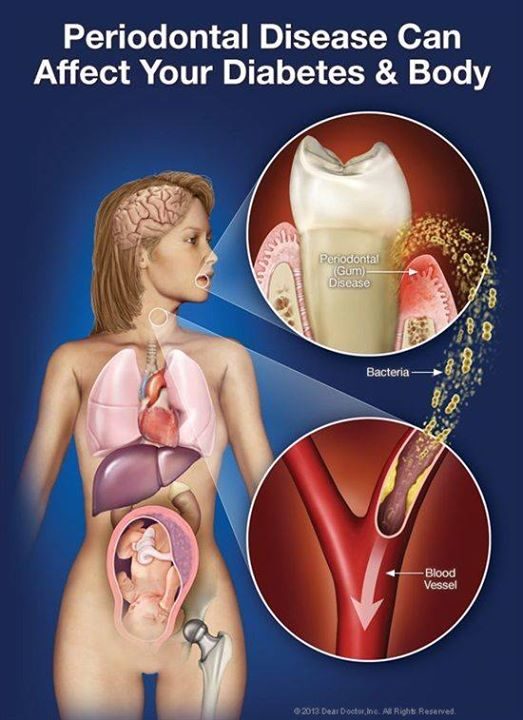 Gum disease and Diabetes