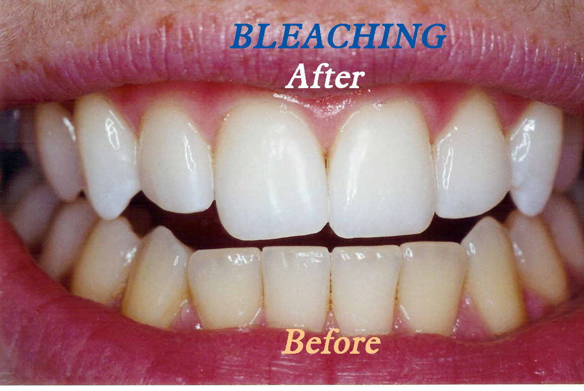 teeth whitening