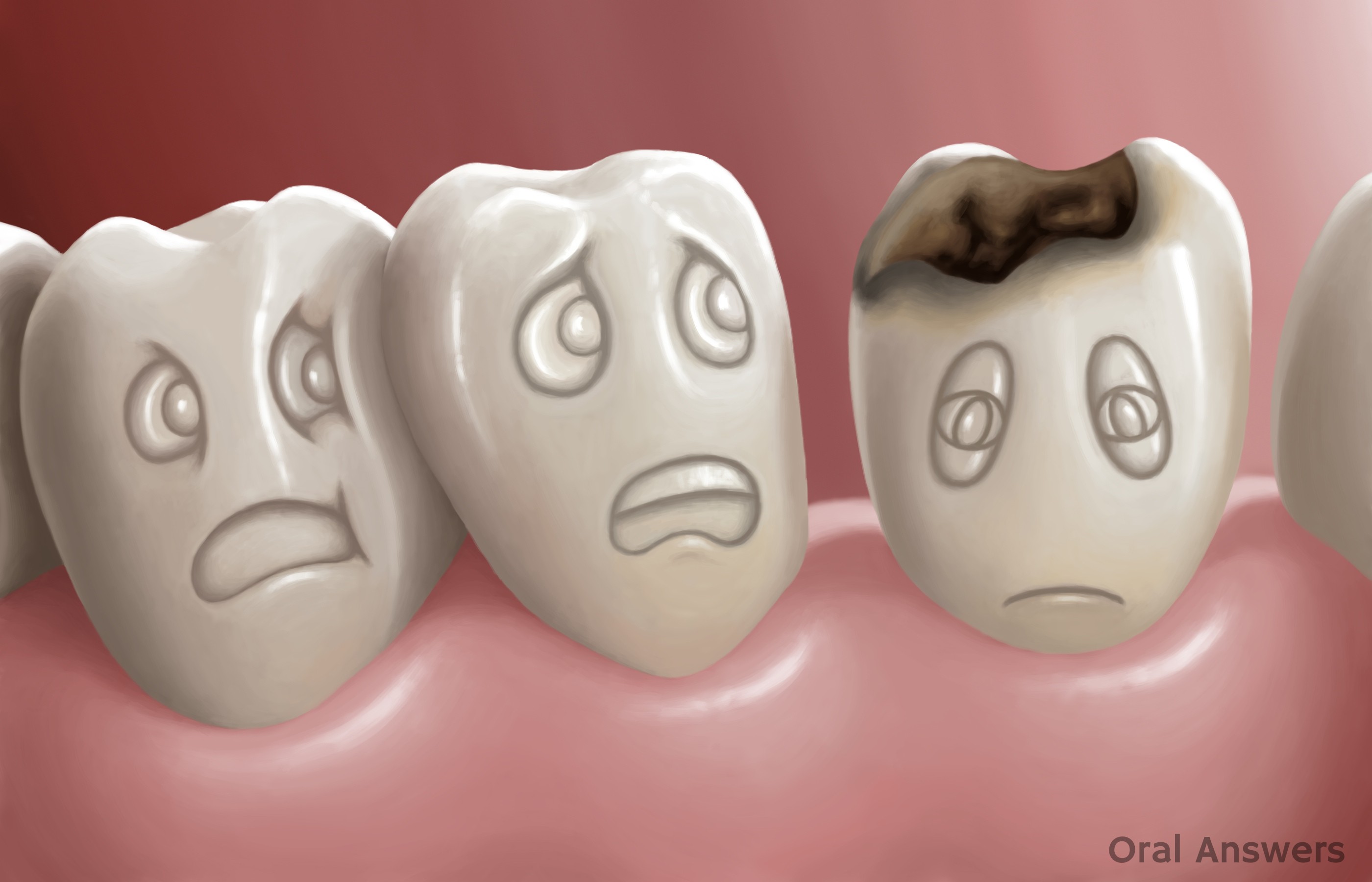 tooth decay