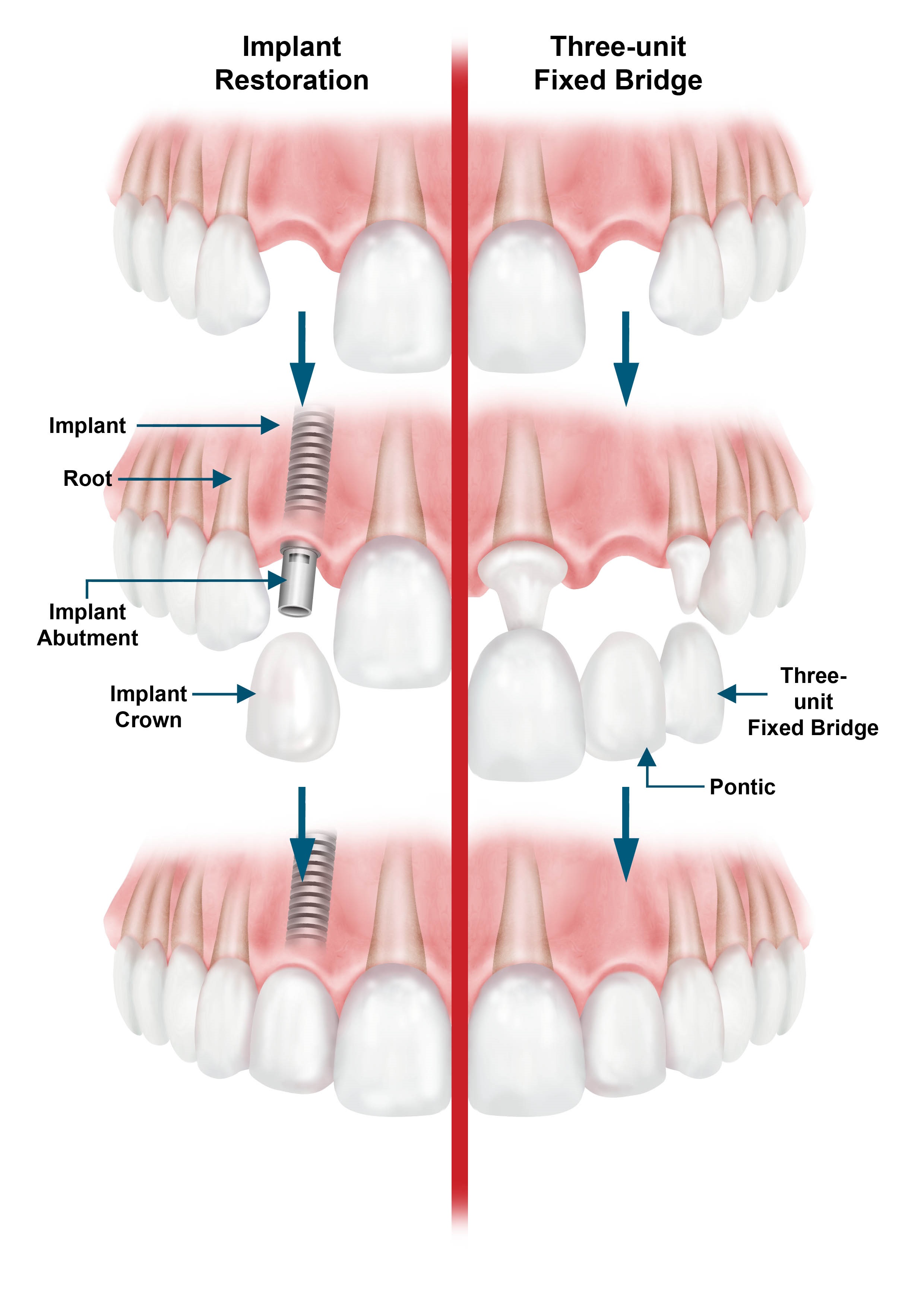 Replacing missing teeth