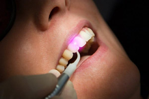 Laser dentistry