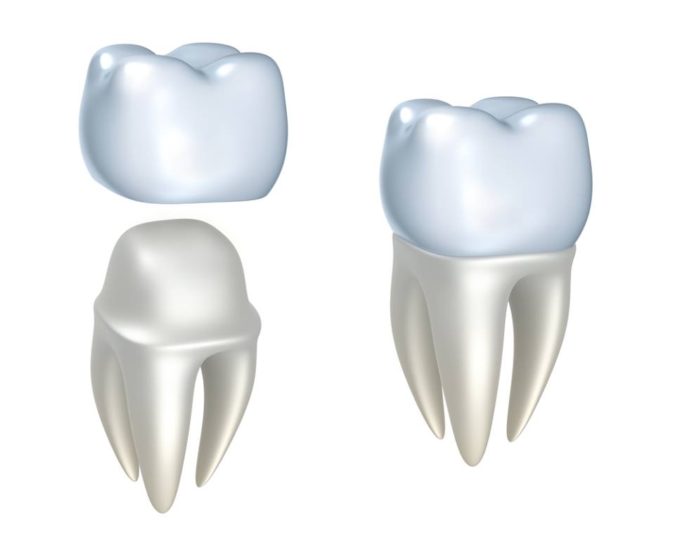 crown cavities