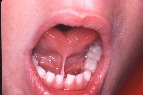 tongue tied