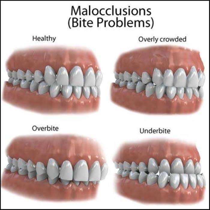 occlusion and malocclusion