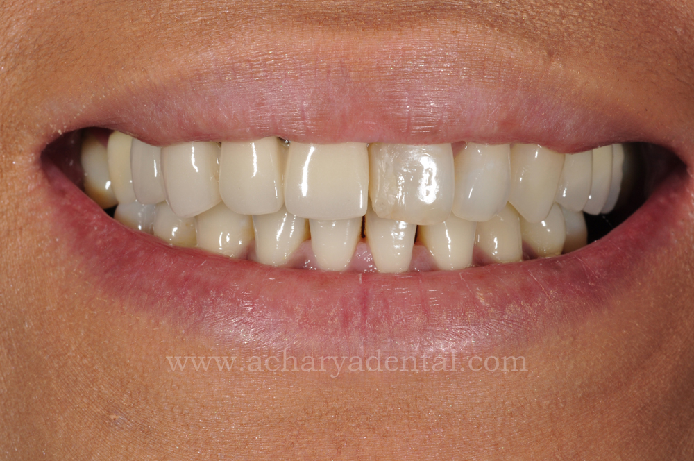 Smile Makeovers before and after