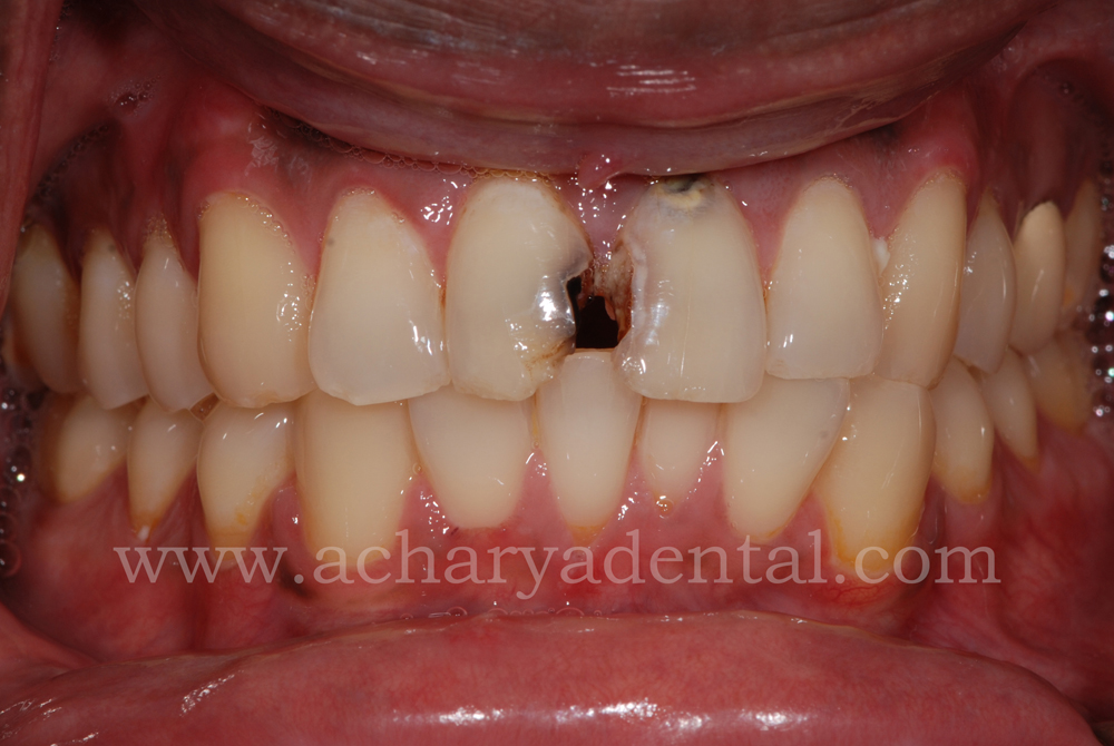Smile Makeovers before and after