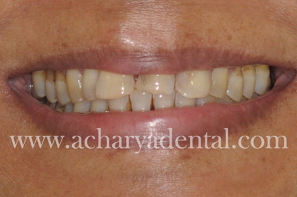 Smile Makeovers before and after