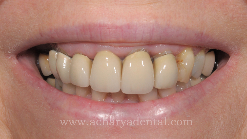Smile Makeovers before and after
