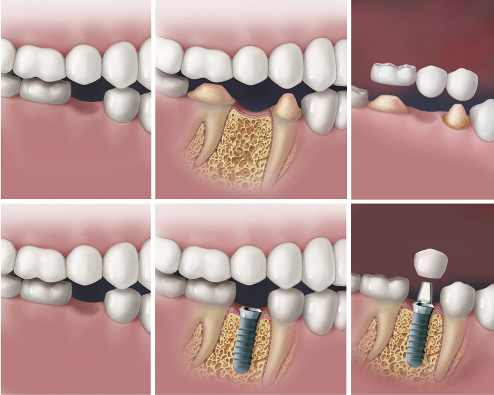 Teeth Replacement Process