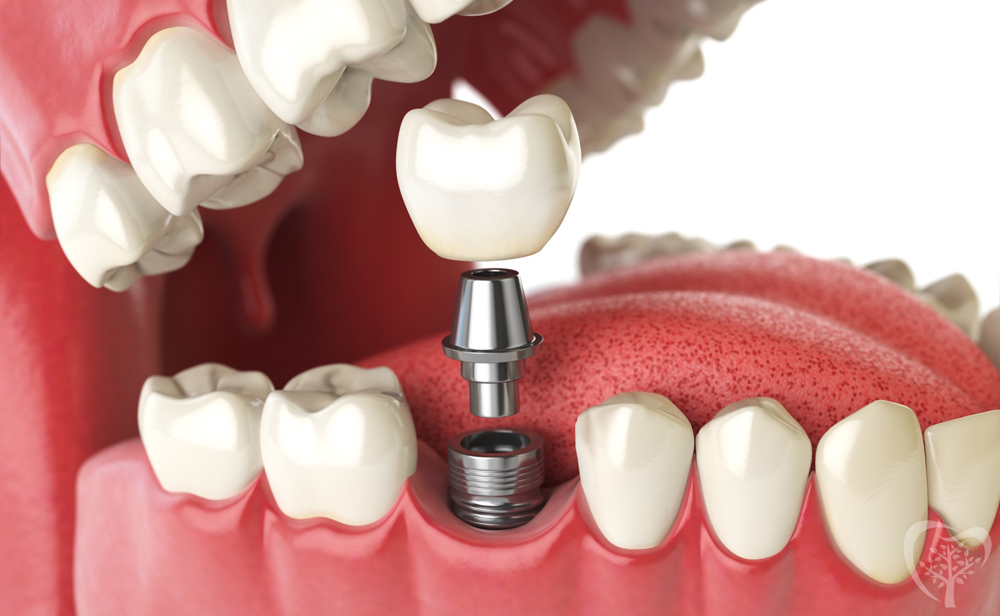 Tooth implant process