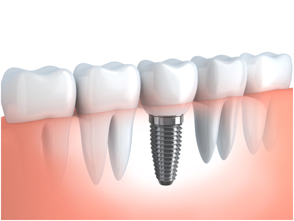 dental implants in chennai