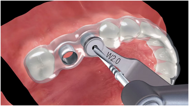 implant dentistry