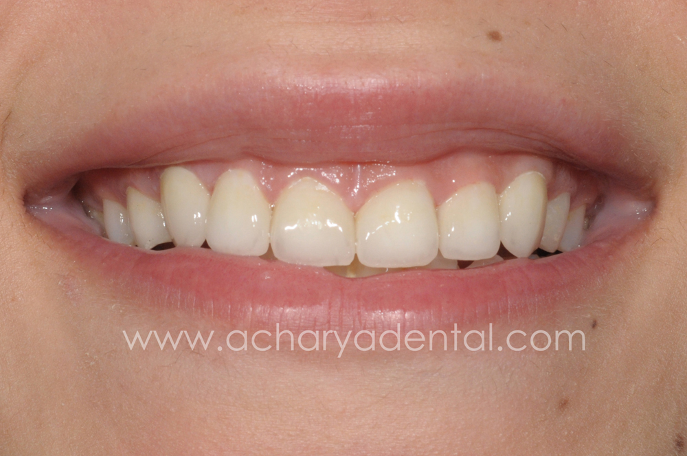 Smile Makeovers before and after