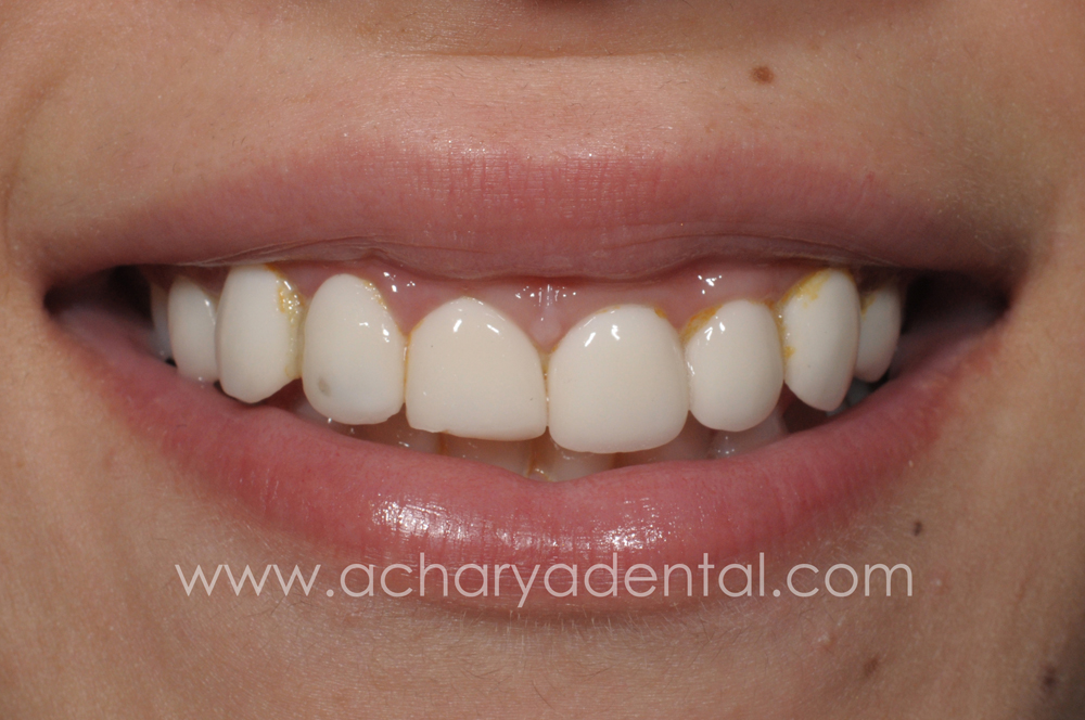 Smile Makeovers before and after