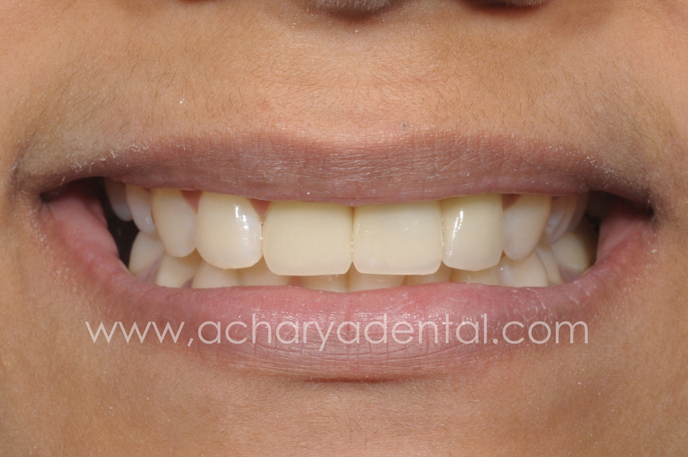 Smile Makeovers before and after
