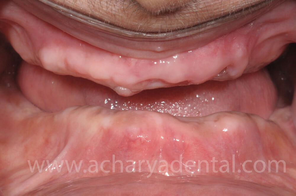 Before Denture