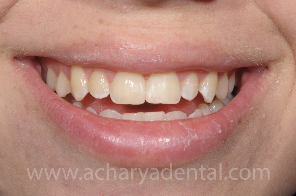Fillings After Treatment