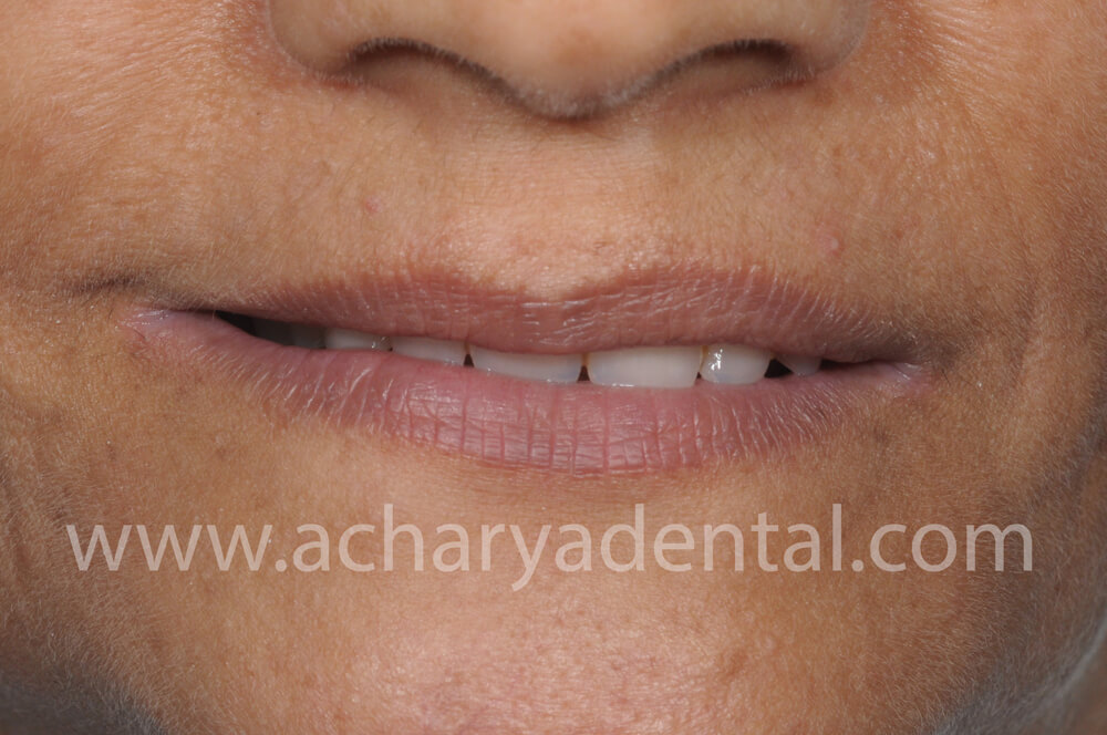Denture After