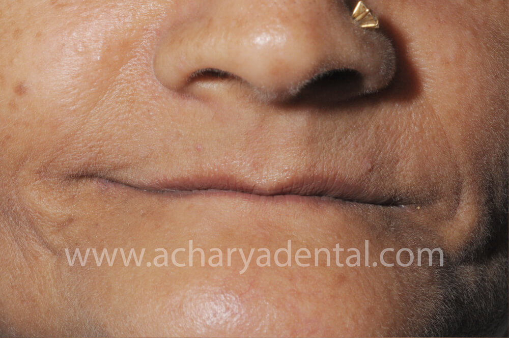 Denture Before