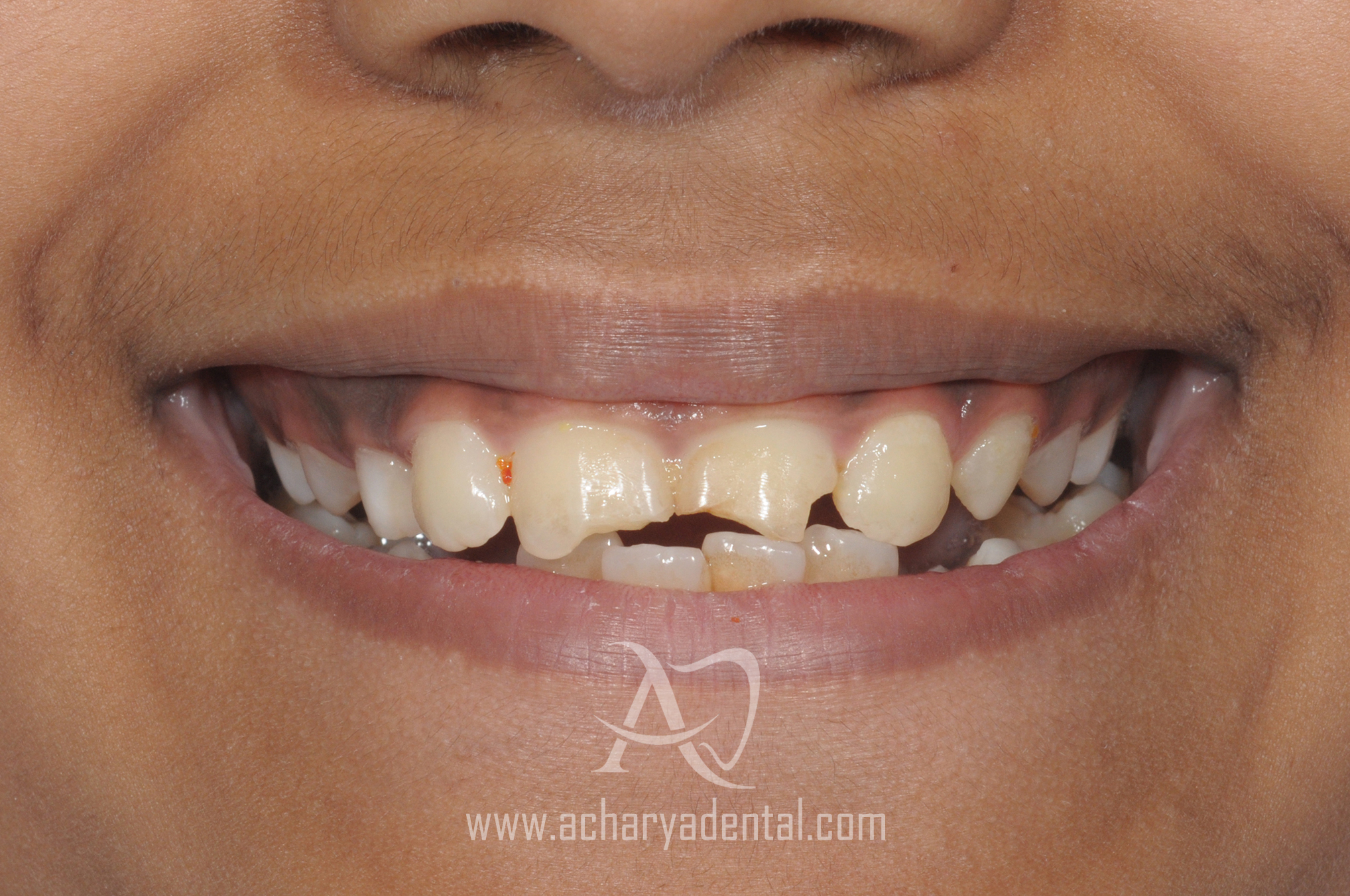 Before smilemakeover diagnosis image