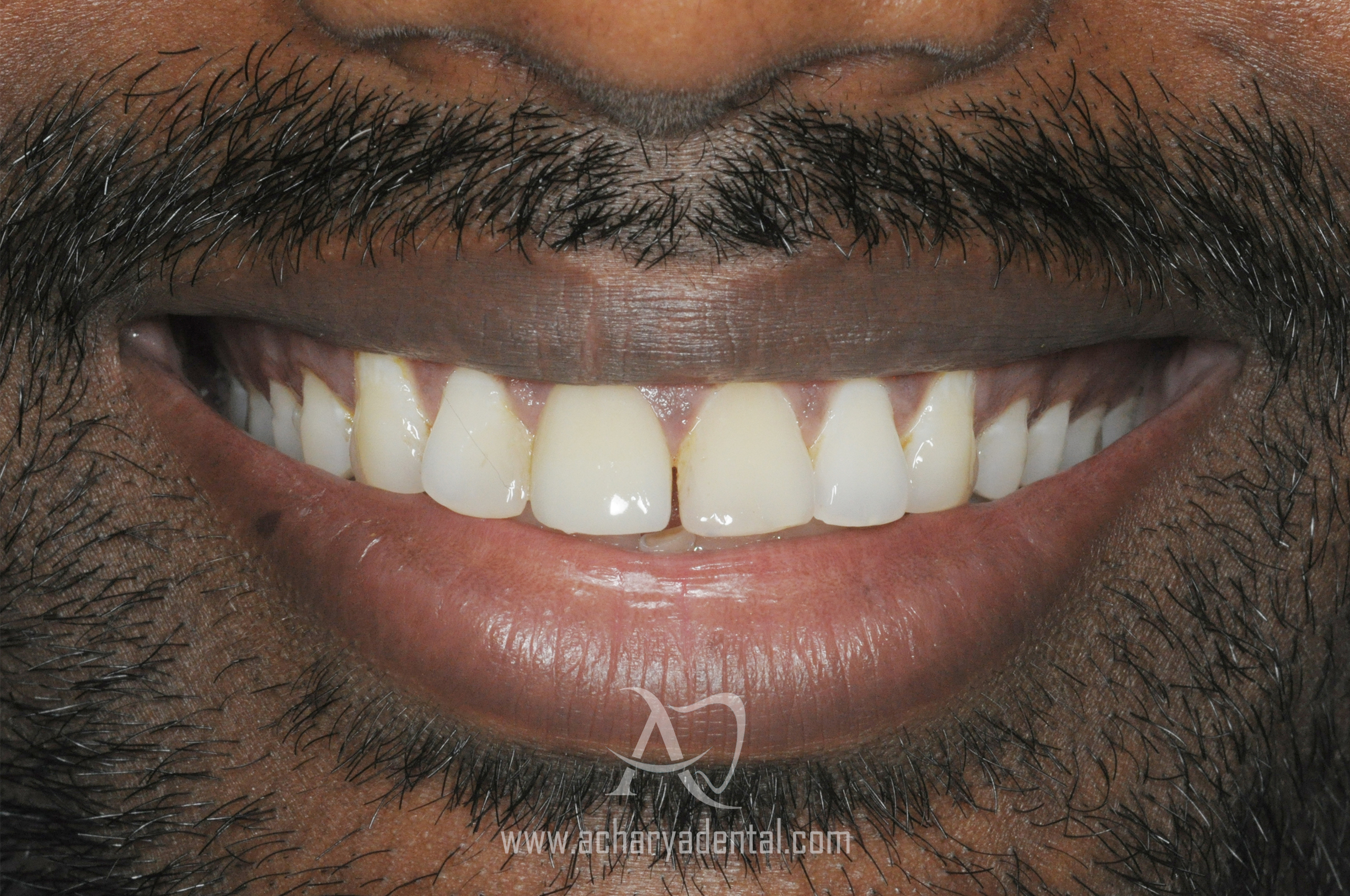 smile makeover pre treatment