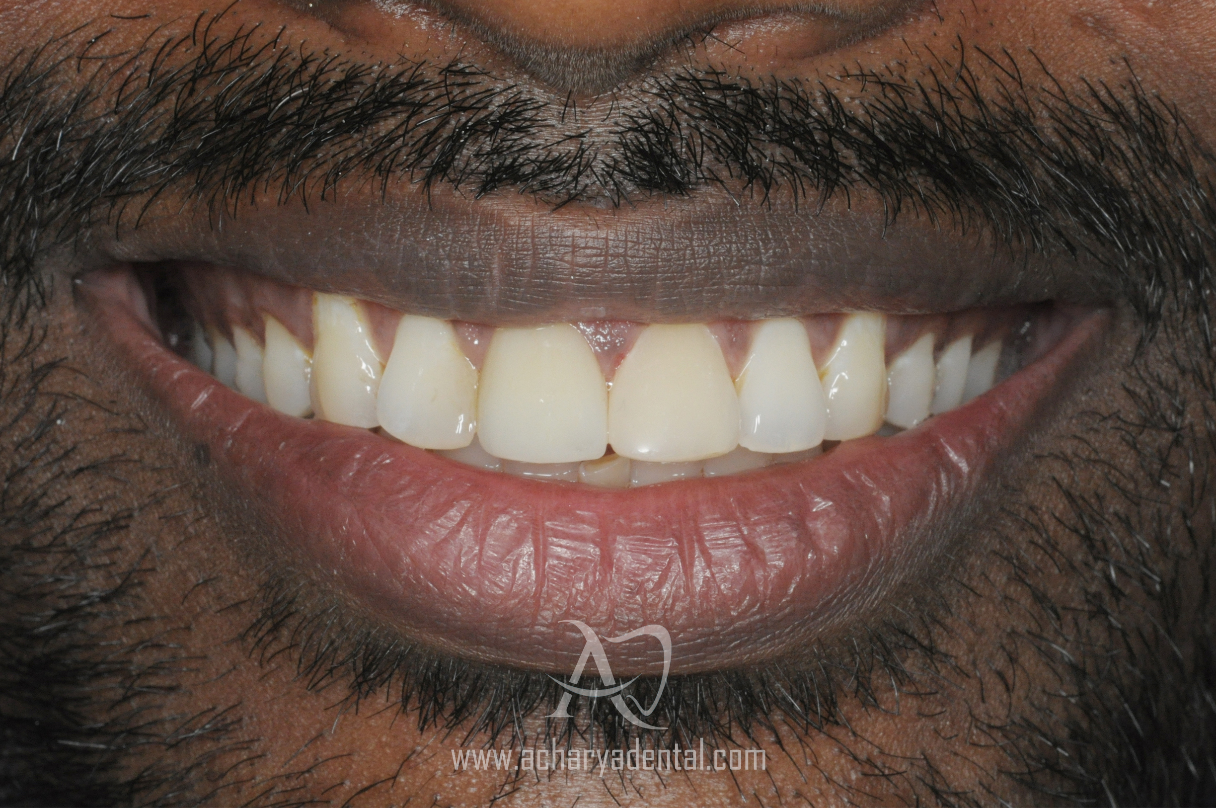 smile makeover post treatment