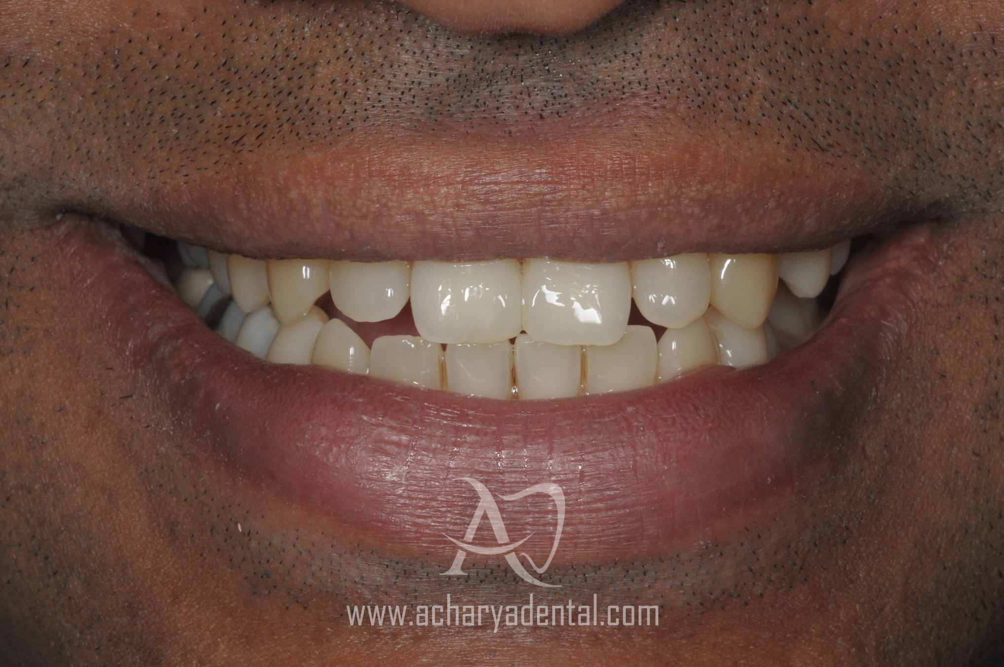 smilemakeover after the treatment
