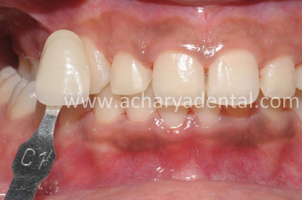 Before teeth whitening