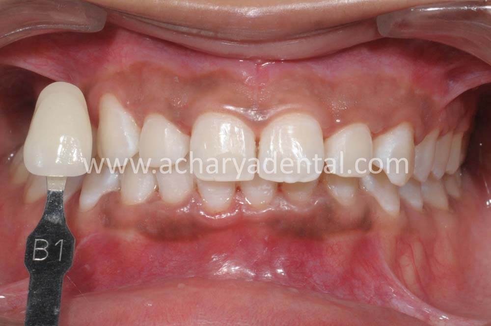 After teeth whitening