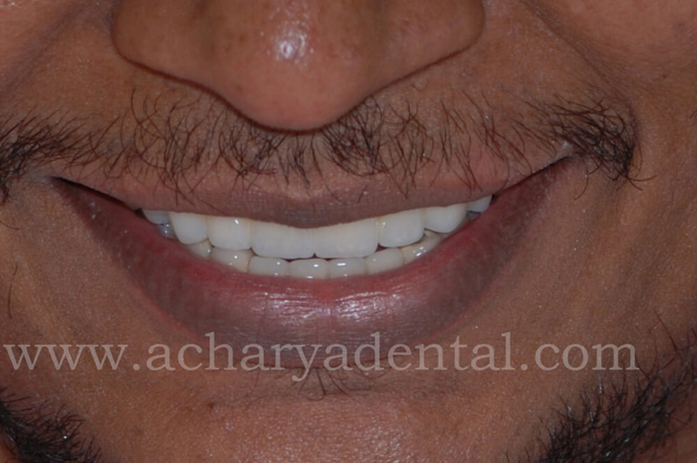 Dental_Implant_post