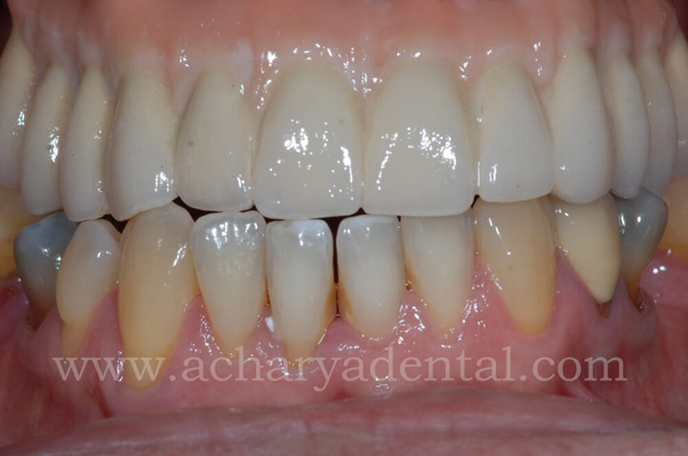 Dental Implant post treatment