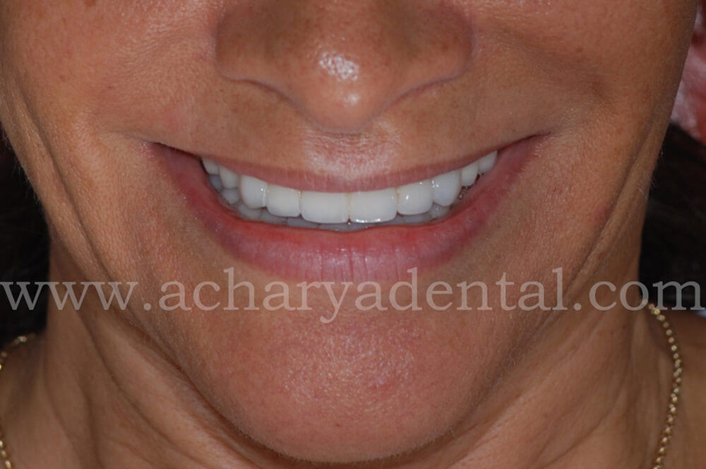 dental implant after diagnosis