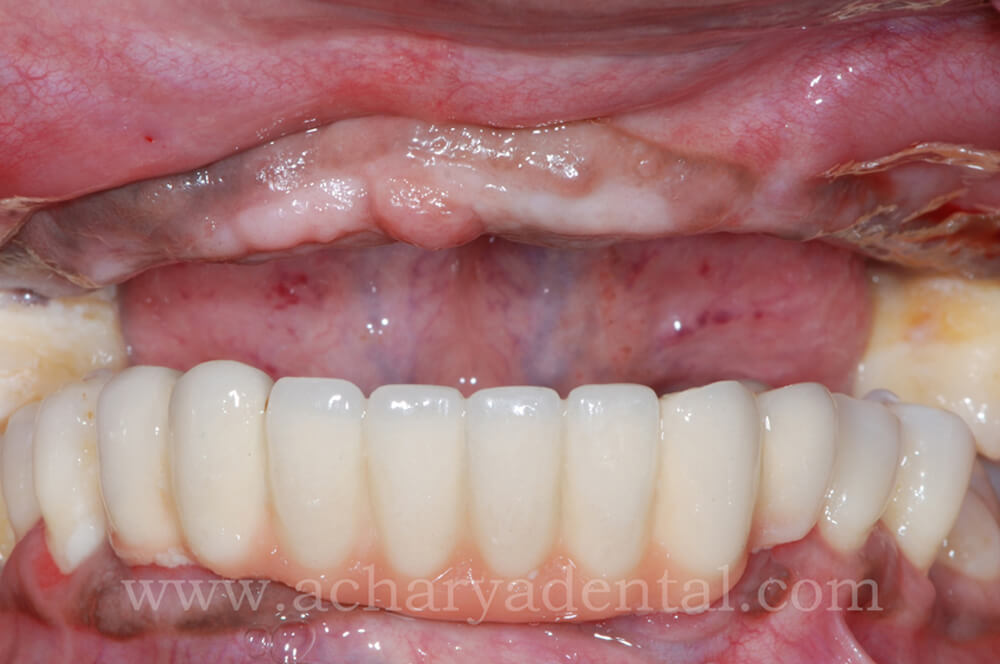 Dental_Implant_pre