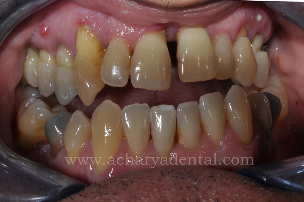 Dental Implant pre treatment