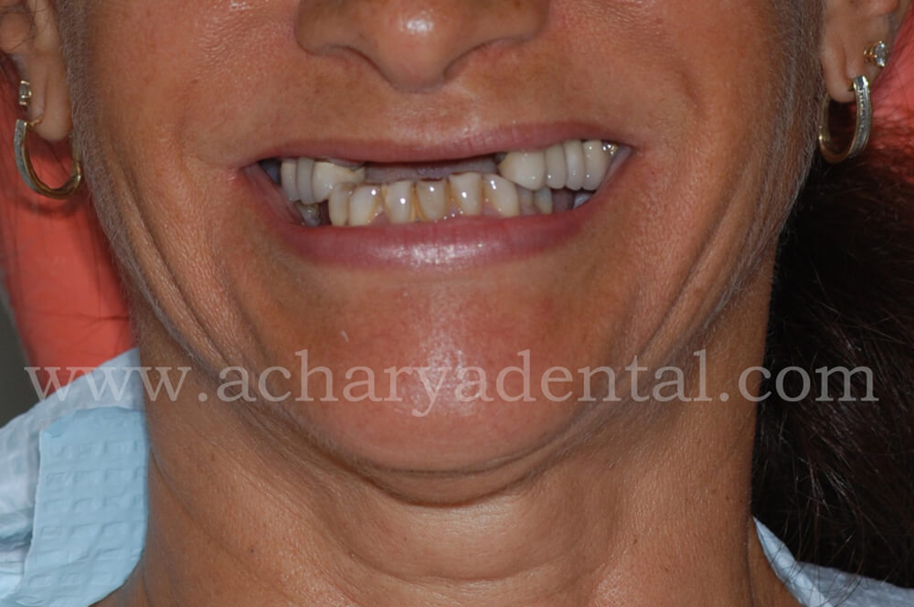 dental implant before diagnosis